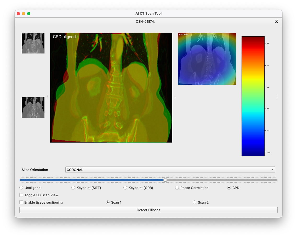 CT Alignment and Lesion Detection screenshot